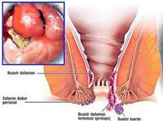 Illustration for article titled Penyakit Wasir Berbahaya Tidak